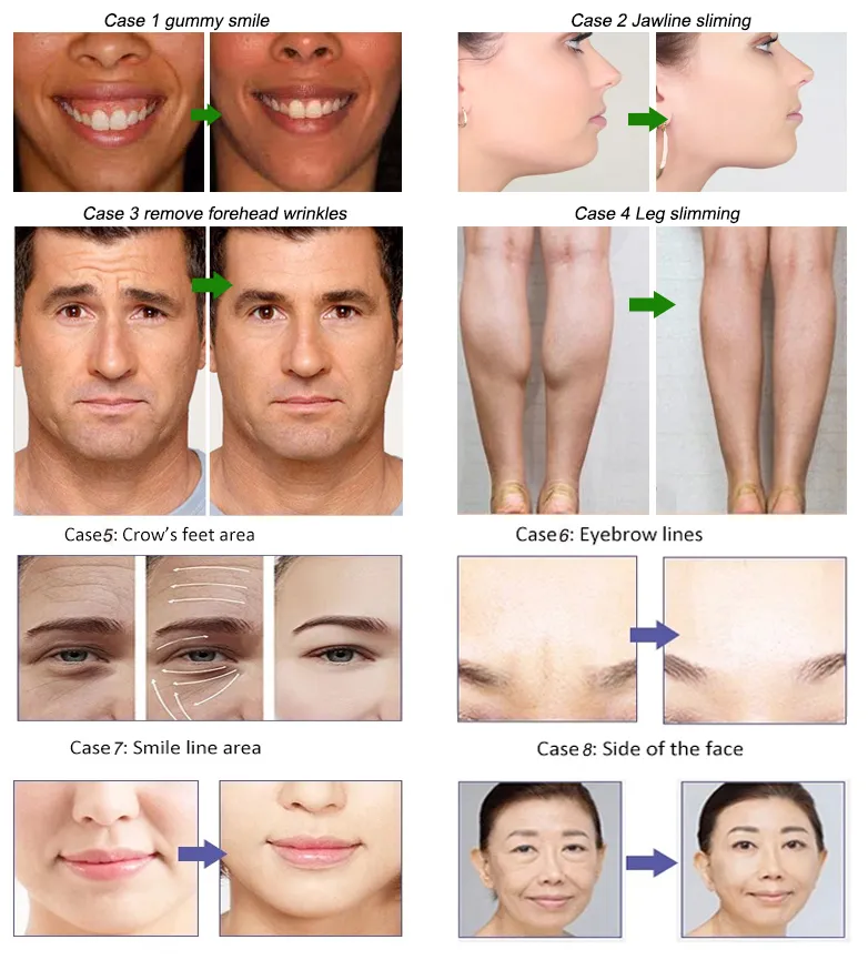 Sfiducianti Antirughe Beutox Batulaxs Resty Dermal Filler Juvederms 1